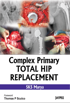 Complex Primary Total Hip Replacement Complex Primary Total Hip Replacement