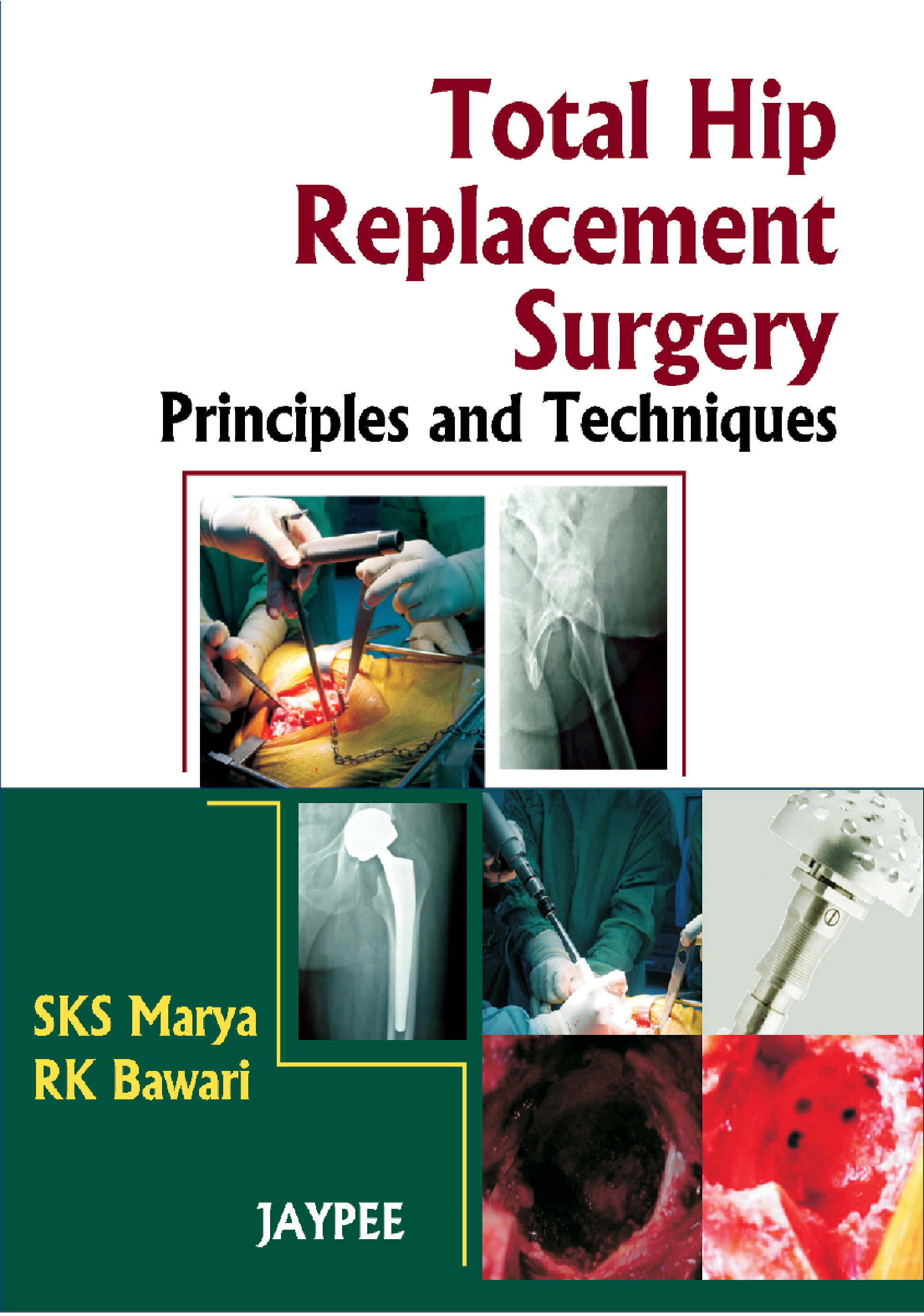 Total Hip Replacement Surgery