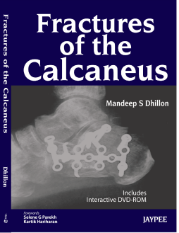 Fractures of the Calcaneus