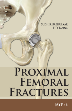 Proximal Femoral Fractures Proximal Femoral Fractures