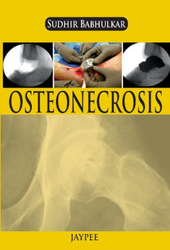 Osteonecrosis Osteonecrosis