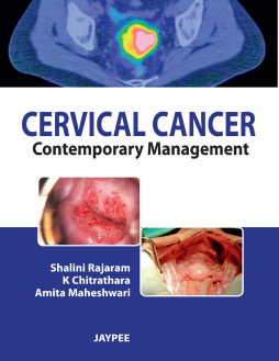 Cervical Cancer: Contemporary Management Cervical Cancer: Contemporary Management