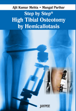 Step by Step® High Tibial Osteotomy by Hemicallotasis Step by Step® High Tibial Osteotomy by Hemicallotasis