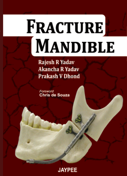 Fracture Mandible Fracture Mandible