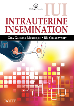 IUI: Intrauterine Insemination IUI: Intrauterine Insemination
