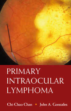 Primary Intraocular Lymphoma Primary Intraocular Lymphoma