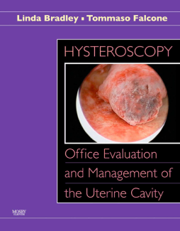 Hysteroscopy: Office Evaluation and Management of the Uterine Cavity E-Book Hysteroscopy: Office Evaluation and Management of the Uterine Cavity E-Book