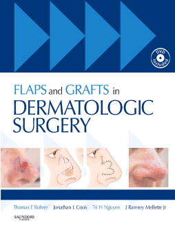 Flaps and Grafts in Dermatologic Surgery E-Book Flaps and Grafts in Dermatologic Surgery E-Book