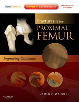 Fractures of the Proximal Femur: Improving Outcomes E-Book Fractures of the Proximal Femur: Improving Outcomes E-Book