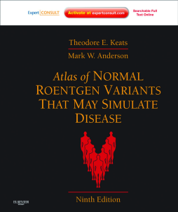 Atlas of Normal Roentgen Variants That May Simulate Disease E-Book Atlas of Normal Roentgen Variants That May Simulate Disease E-Book