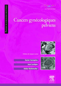 Cancers gynécologiques pelviens Cancers gynécologiques pelviens