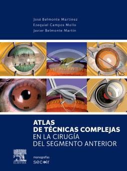 Atlas de técnicas complejas en la cirugía del segmento anterior Atlas de técnicas complejas en la cirugía del segmento anterior