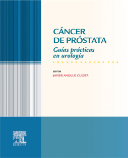 Cáncer de próstata Cáncer de próstata