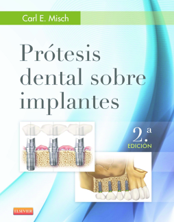 Prótesis dental sobre implantes Prótesis dental sobre implantes