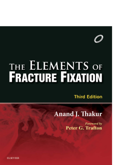 Elements of Fracture Fixation - E-book Elements of Fracture Fixation - E-book