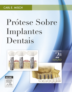 Prótese sobre Implantes Dentais Prótese sobre Implantes Dentais