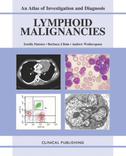 Lymphoid Malignancies: an Atlas of Investigation and Diagnosis Lymphoid Malignancies: an Atlas of Investigation and Diagnosis