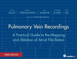 Pulmonary Vein Recordings : A Practical Guide to the Mapping and Ablation of Atrial Fibrillation Vol 3 Pulmonary Vein Recordings : A Practical Guide to the Mapping and Ablation of Atrial Fibrillation Vol 3