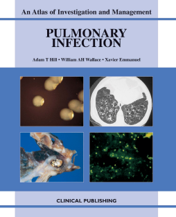 Pulmonary Infection: an Atlas of Investigation and Diagnosis Pulmonary Infection: an Atlas of Investigation and Diagnosis