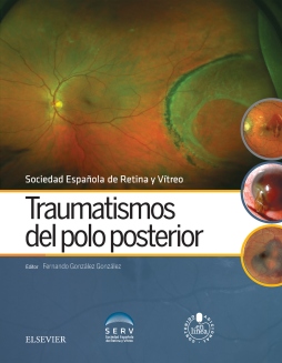 Traumatismos del polo posterior Traumatismos del polo posterior