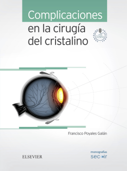 Complicaciones en la cirugía del cristalino Complicaciones en la cirugía del cristalino