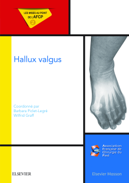 Hallux valgus Hallux valgus