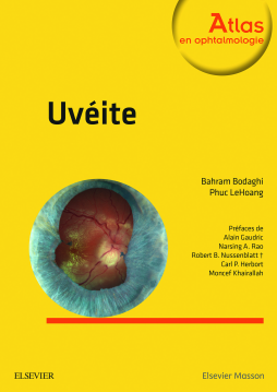 Uvéite Uvéite