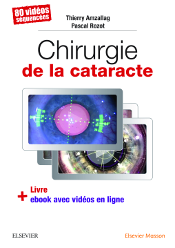 Chirurgie de la cataracte Chirurgie de la cataracte