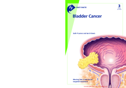 Fast Facts: Bladder Cancer Fast Facts: Bladder Cancer
