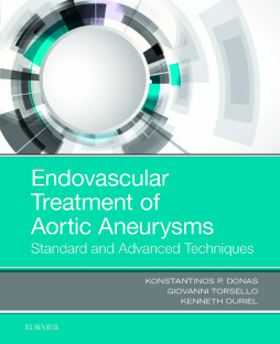 Endovascular Treatment of Aortic Aneurysms Endovascular Treatment of Aortic Aneurysms