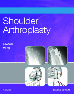 Shoulder Arthroplasty E-Book