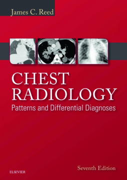 Chest Radiology: Patterns and Differential Diagnoses E-Book Chest Radiology: Patterns and Differential Diagnoses E-Book