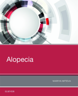 Alopecia Alopecia