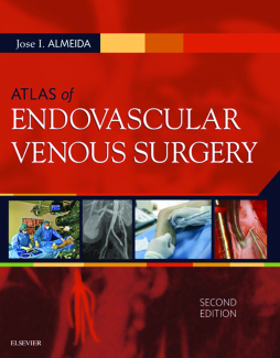 Atlas of Endovascular Venous Surgery E-Book Atlas of Endovascular Venous Surgery E-Book