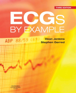 ECGs by Example E-Book