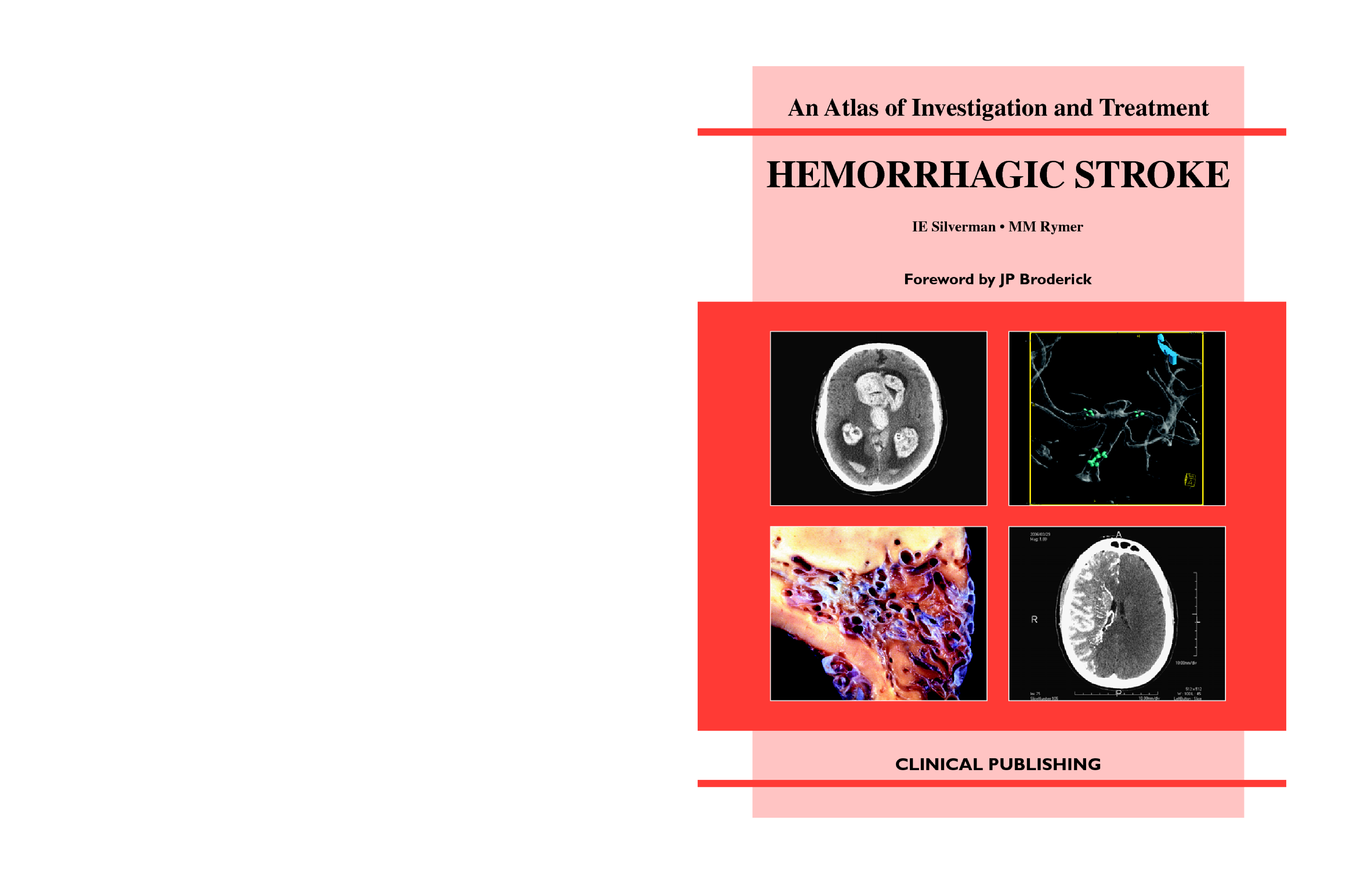 Hemorrhagic Stroke: an Atlas of Investigation and Treatment
