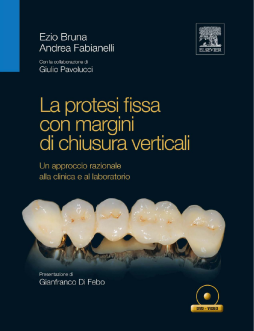La protesi fissa con margini di chiusura verticali La protesi fissa con margini di chiusura verticali