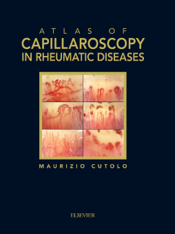 Atlas of capillaroscopy in rheumatic diseases Atlas of capillaroscopy in rheumatic diseases