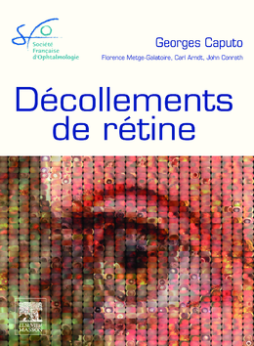 Décollements de rétine Décollements de rétine