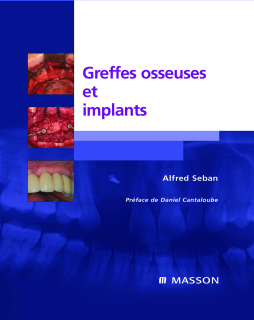 Greffes osseuses et implants Greffes osseuses et implants
