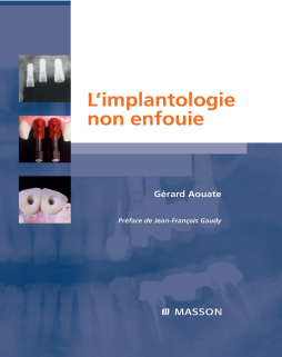 L'implantologie non enfouie L'implantologie non enfouie