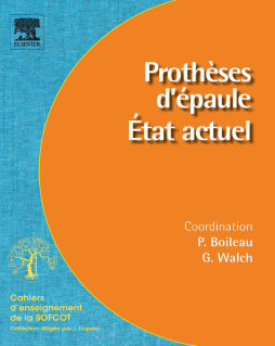 Prothèses d'épaule. État actuel Prothèses d'épaule. État actuel