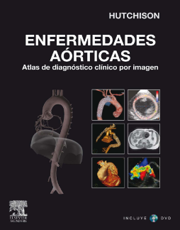 Enfermedades aórticas Enfermedades aórticas