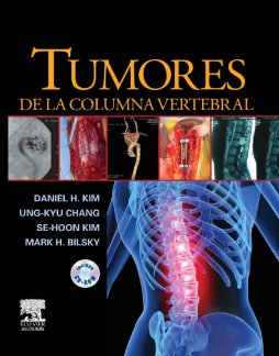 Tumores de la columna vertebral Tumores de la columna vertebral