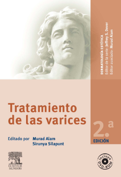 Tratamiento de las varices Tratamiento de las varices