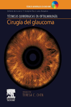 Cirugía del glaucoma Cirugía del glaucoma