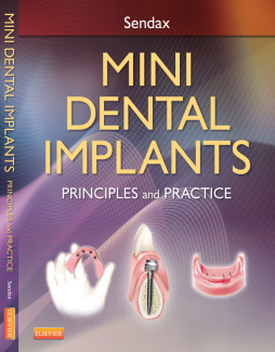 Mini Dental Implants - E-Book Mini Dental Implants - E-Book