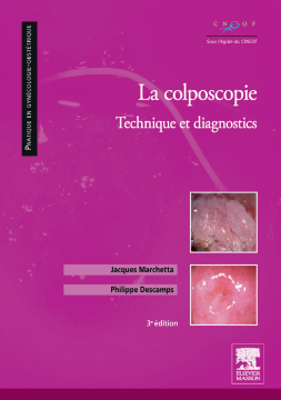 La colposcopie La colposcopie