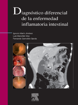 Diagnóstico diferencial de la enfermedad inflamatoria intestinal Diagnóstico diferencial de la enfermedad inflamatoria intestinal